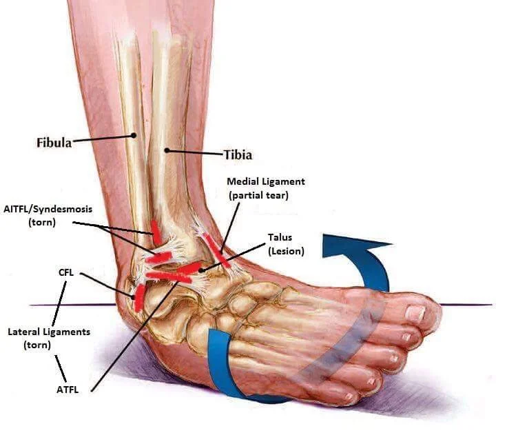 Ankle Arthroscopy in Nagpur
